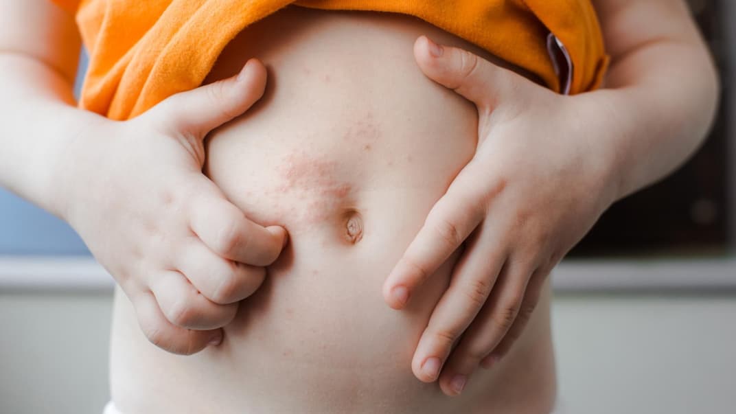 Eine Junge hat einen Hauttausschlag am Bauch. 