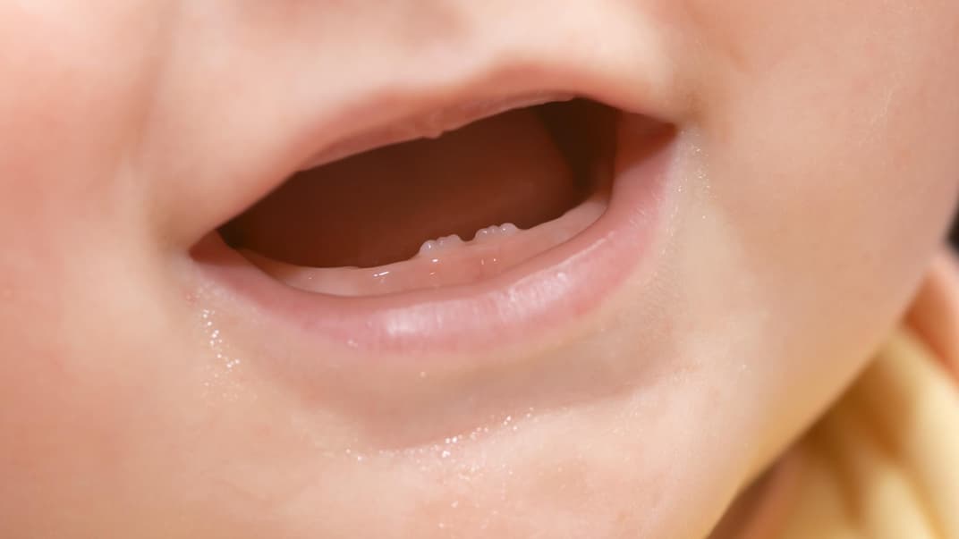 Hexenzähne: Wenn Babys mit Milchzähnen zur Welt kommen