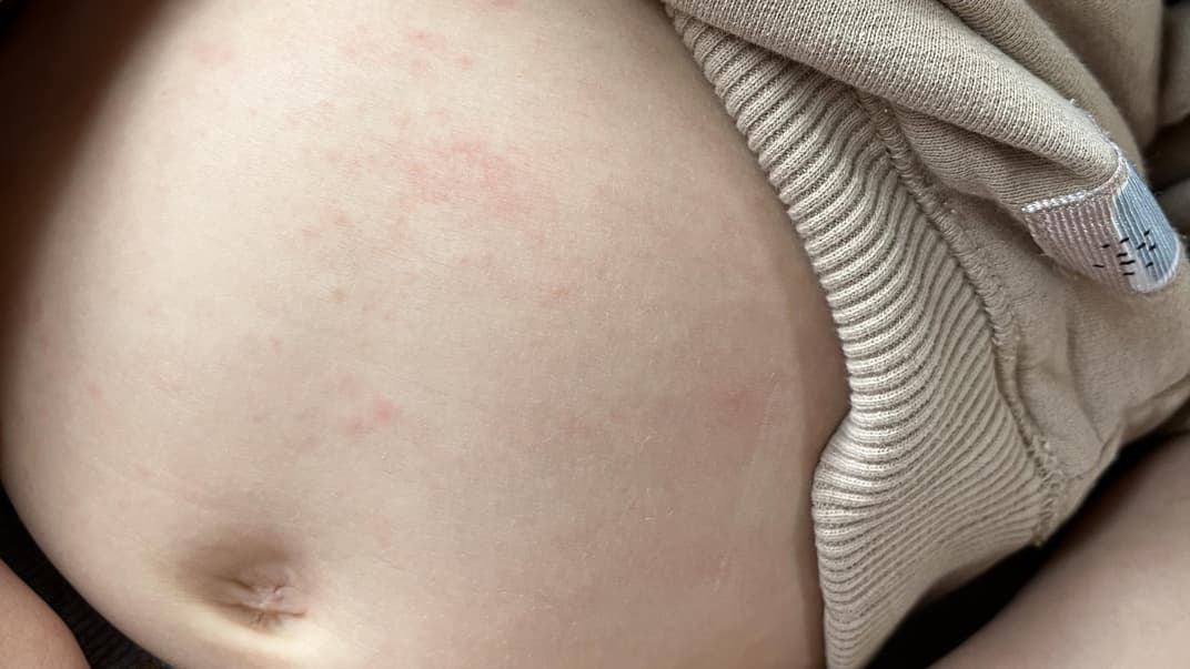 So sieht Scharlach bei Kindern aus