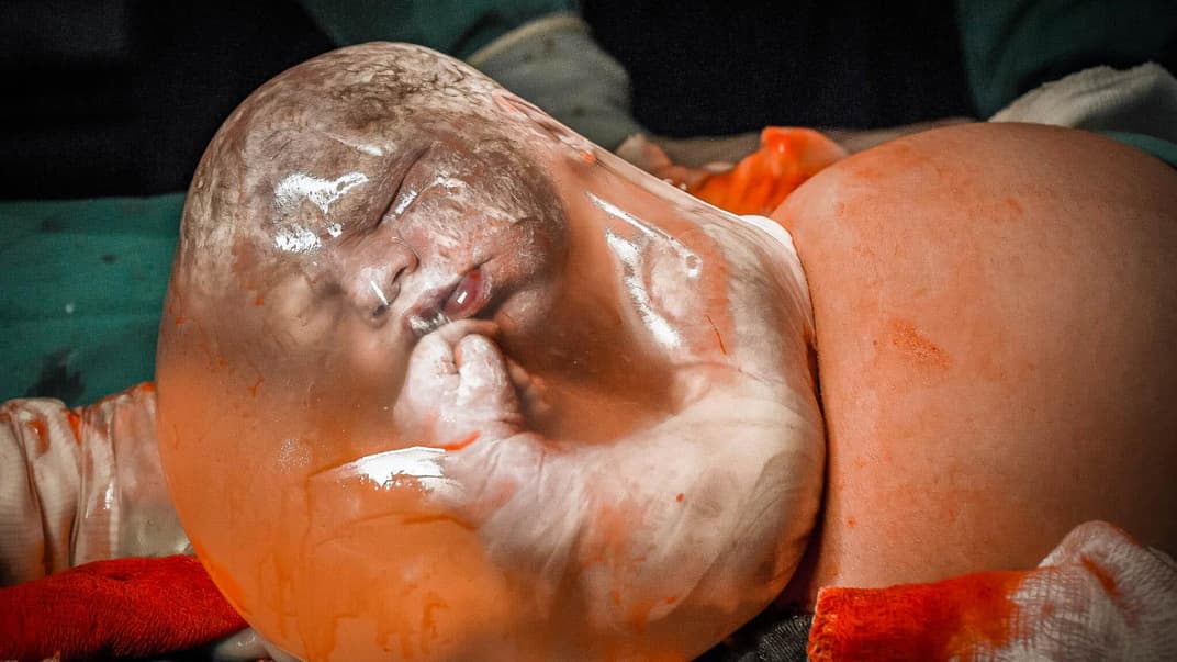 Ein Baby kommt in einer intakten Fruchtblase zur Welt.