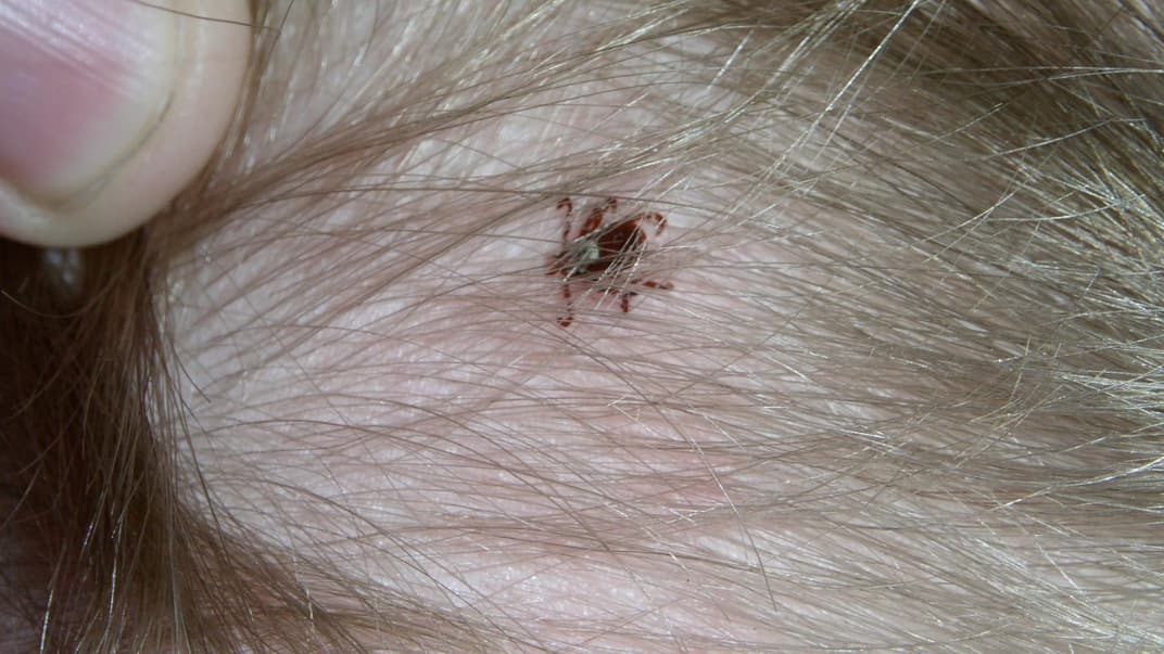 Zecke auf dem Kopf eines Kindes