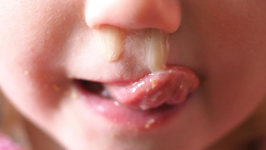 Kind mit dickem Schnodder