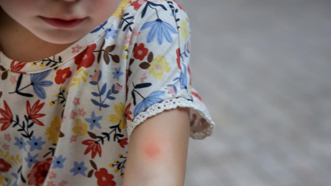 Mädchen mit Mückenstich am Arm