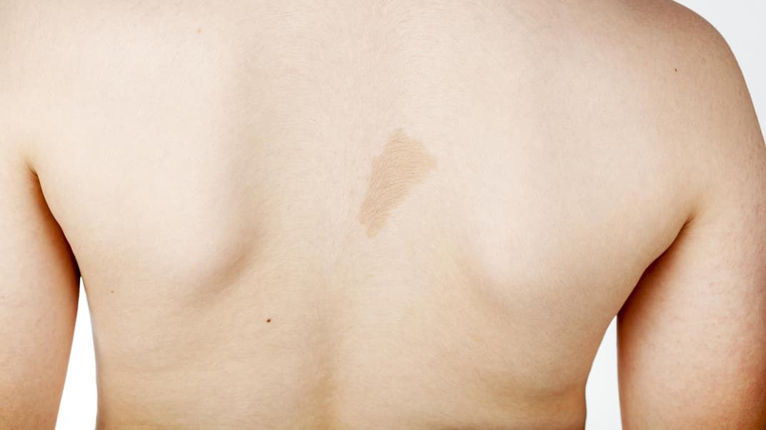 Brauner Fleck auf Kinderrücken