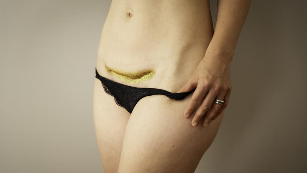 Eine vergoldete Kaiserschnittnarbe