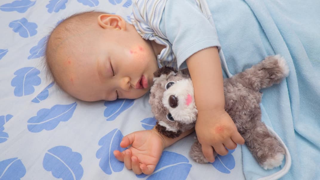 Schlafendes Baby mit Mückenstichen im Gesicht.