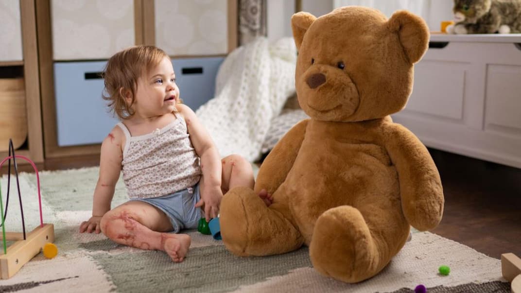 Das Bein des kleinen Mädchens ist von der Meningokokken-Erkrankung gezeichnet. Wie schwer die Folgeschäden sind, lässt sich auch heute noch nicht abschätzen.