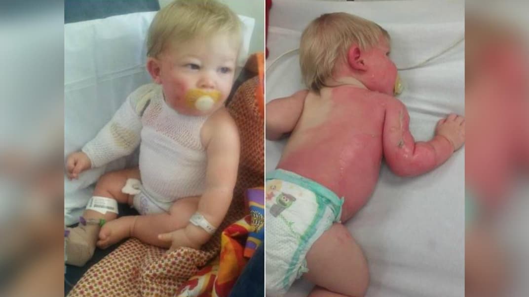 30 Prozent des kleinen Körpers von Nicholas waren nach dem Gartenschlauch-Unfall verbrannt.