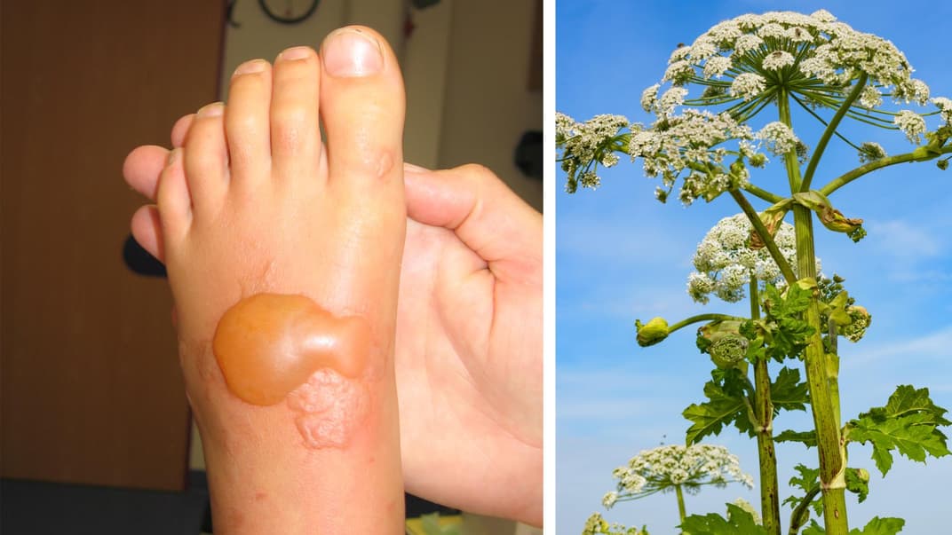Ein Fuß mit einer Brandblase, daneben ein Bild des Riesenbärenklau-Pflanze.