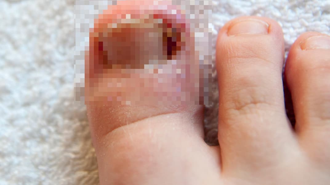 Ein eingewachsener Zehnagel kann Kinder ganz schön quälen.