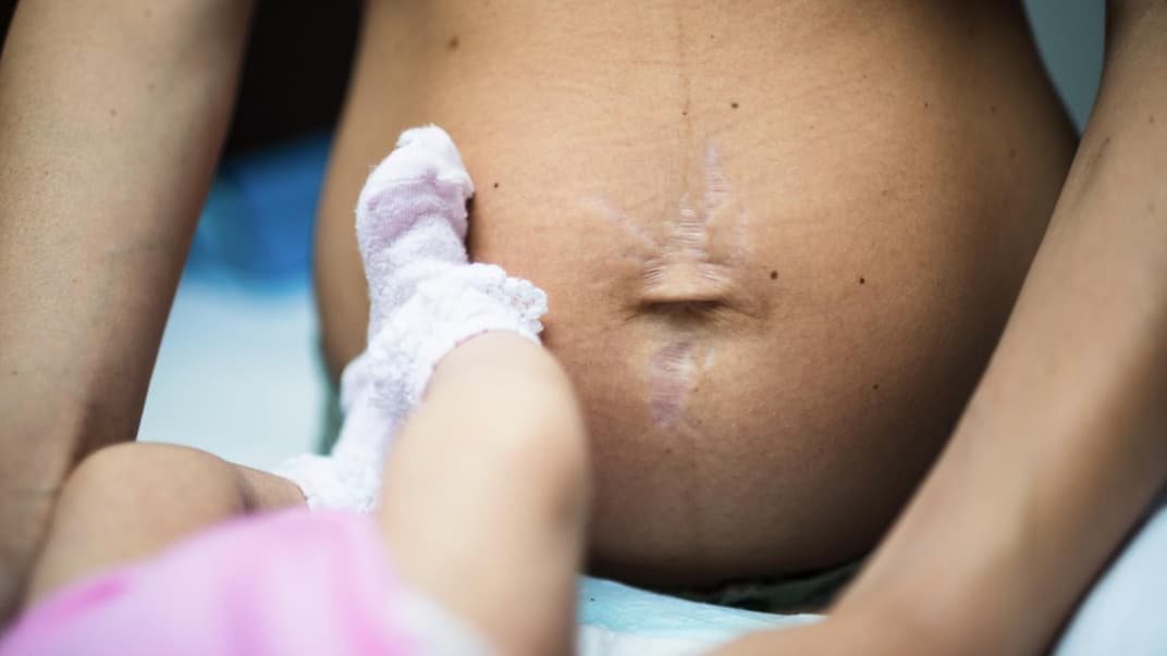 Aus bestimmten Gründen ist es gar nicht möglich, dass der Bauch nach der Geburt gleich wieder flach ist.