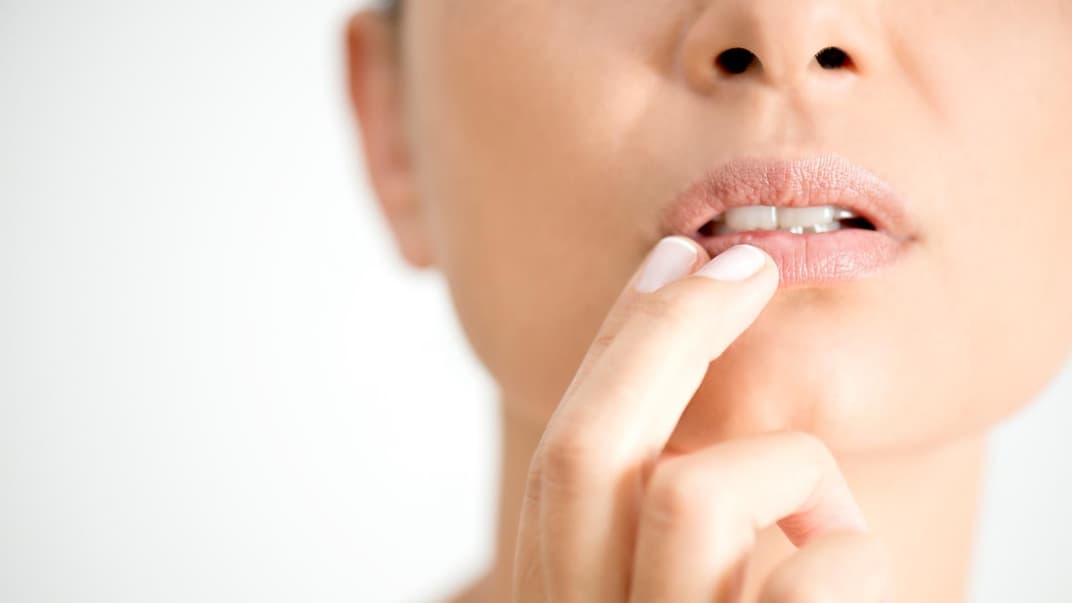 Bei Lippenherpes kommt häufig der Wirkstoff Aciclovir zum Einsatz. Auch in der Schwangerschaft darf er eingesetzt werden. 