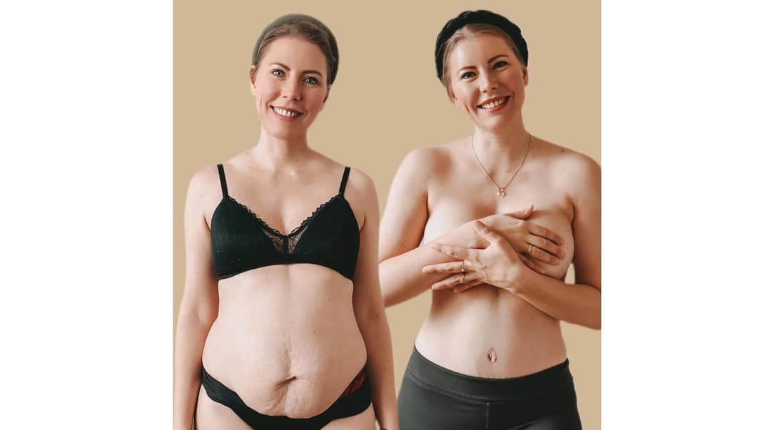 Offen und ehrlich: Janina Westphal teilt das Ergebnis ihrer Rektusdiastase-OP und ihre Erfahrungen mit ihren Followern.