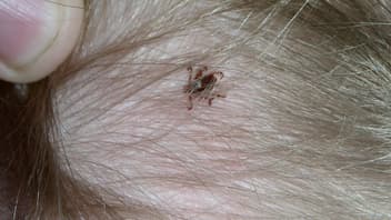 Zecke auf dem Kopf eines Kindes