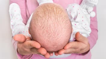 Kopf eines Babys mit Milchschorf