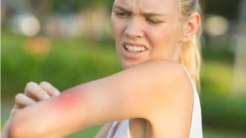 Eine schwangere Frau hat einen Wespenstich am Arm.
