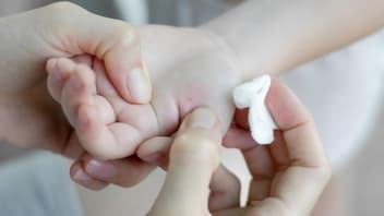 Kinderhand mit Splitter.