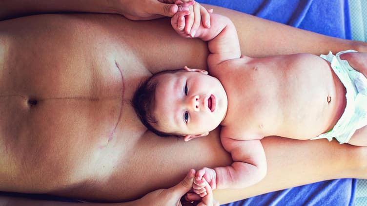 Baby liegt auf Mutter mit Kaiserschnittnarbe.