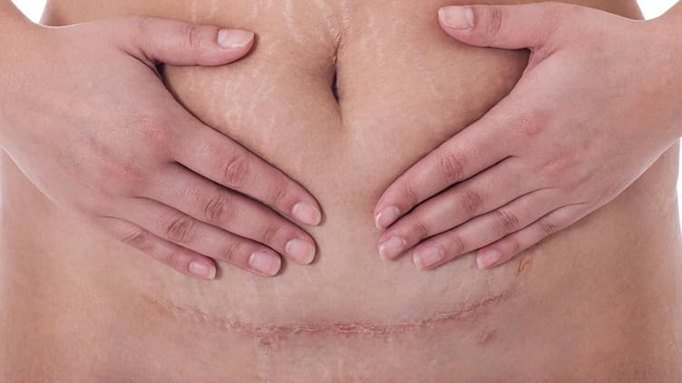 Bauch mit Kaiserschnittnarbe.