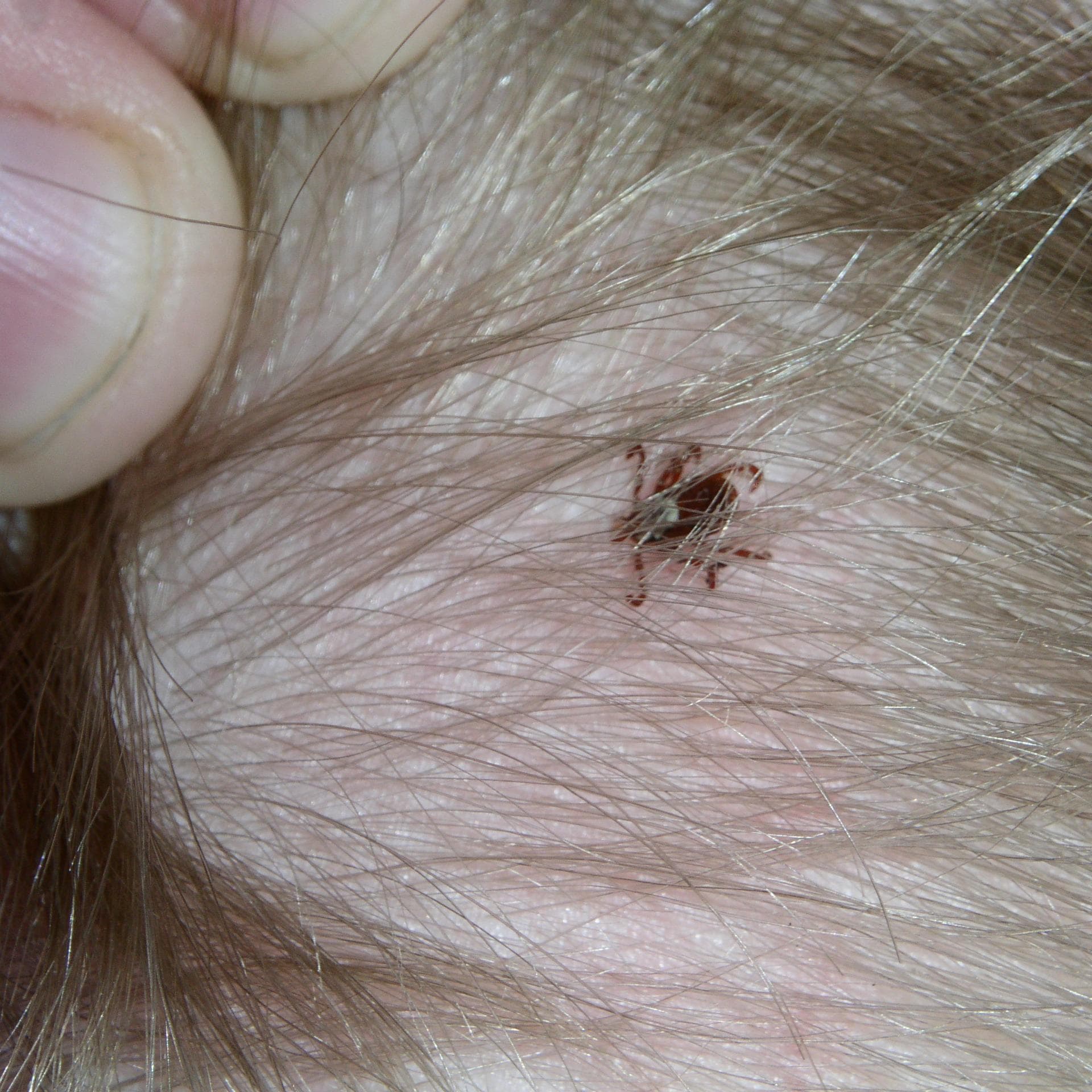 Zecke auf dem Kopf eines Kindes