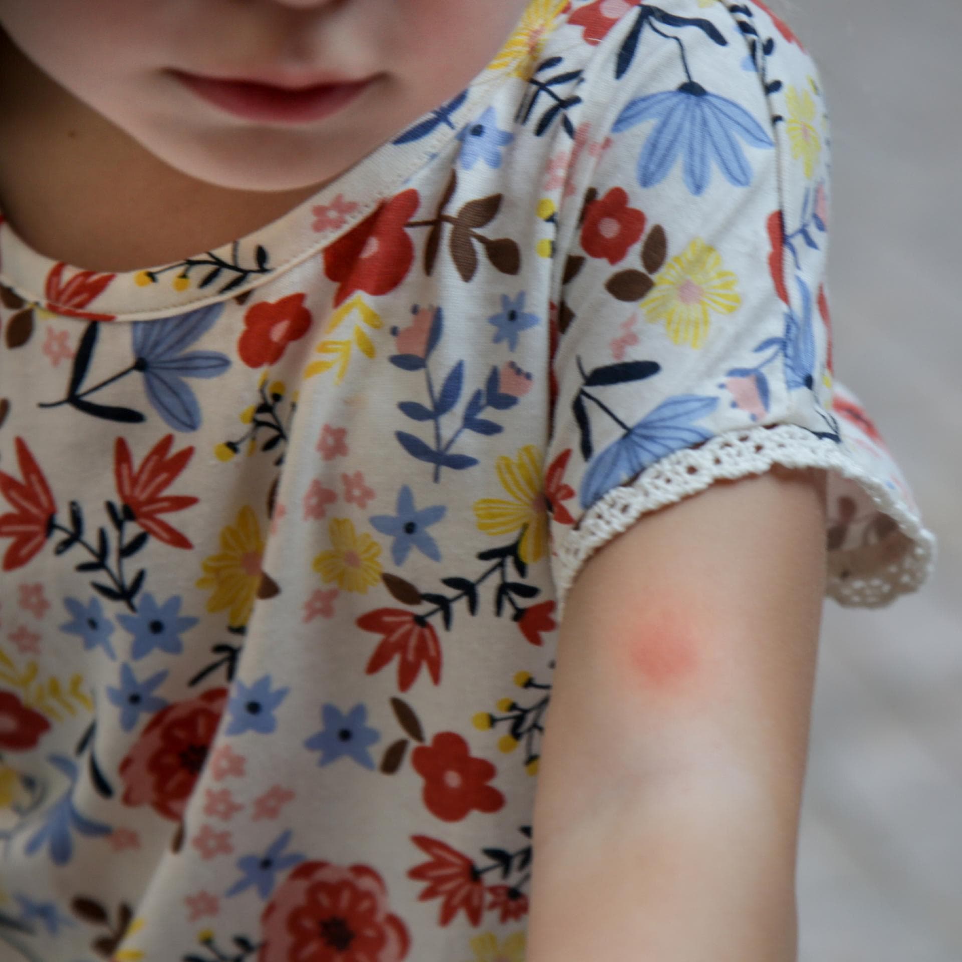 Mädchen mit Mückenstich am Arm