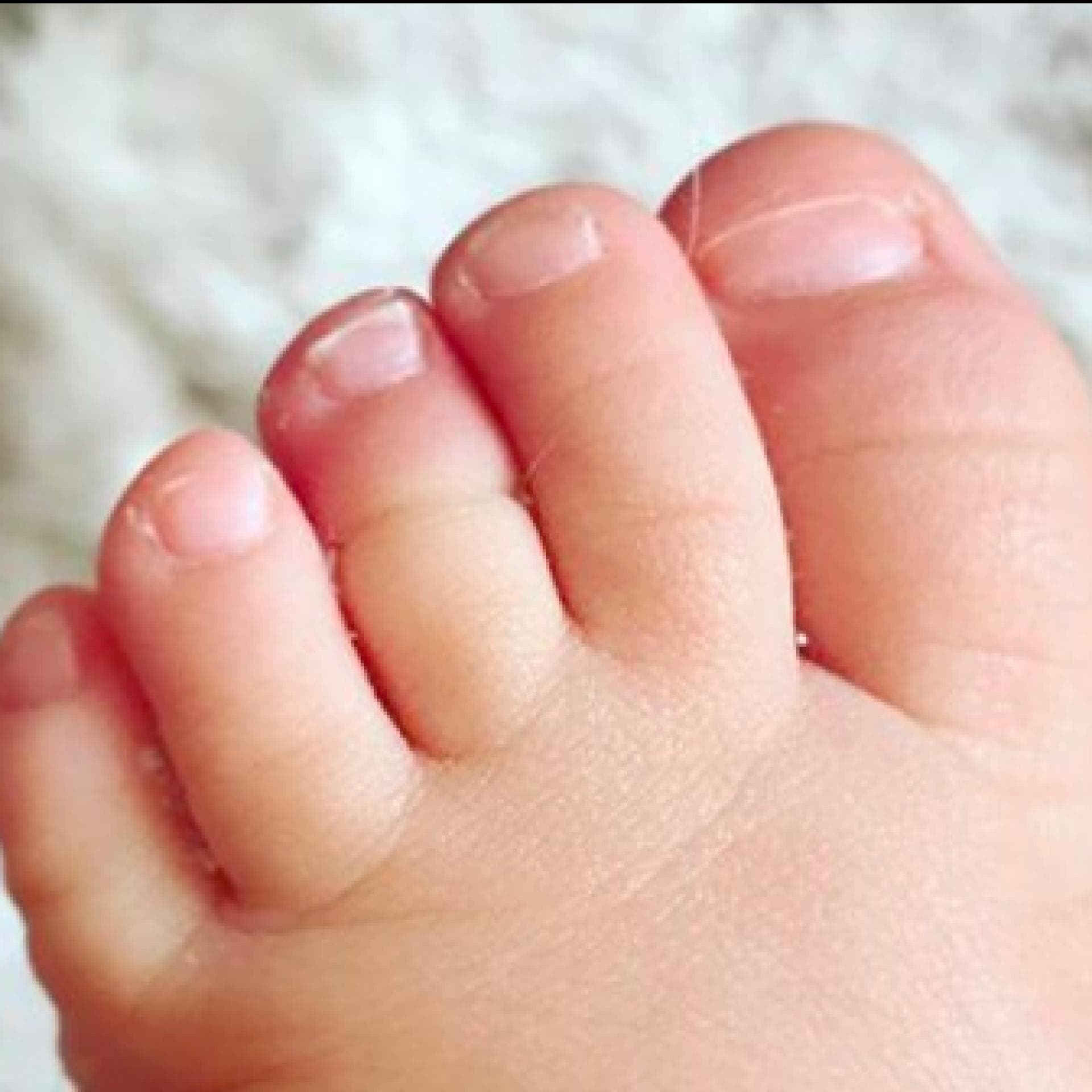 Beim Tourniquet-Syndrom wickelt sich ein Haar um den Zeh und kann so die Blutzufuhr abschnüren. 