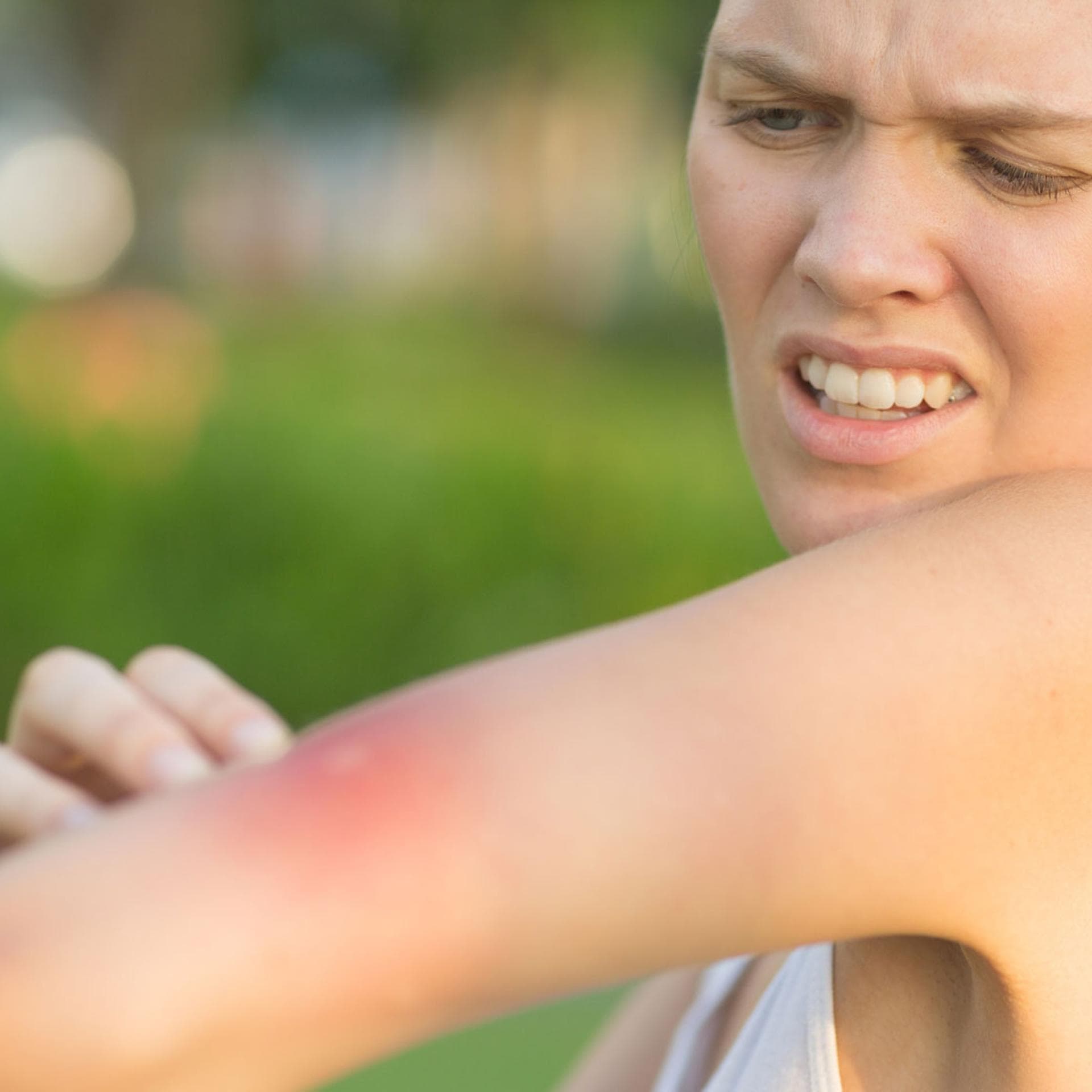 Eine schwangere Frau hat einen Wespenstich am Arm.
