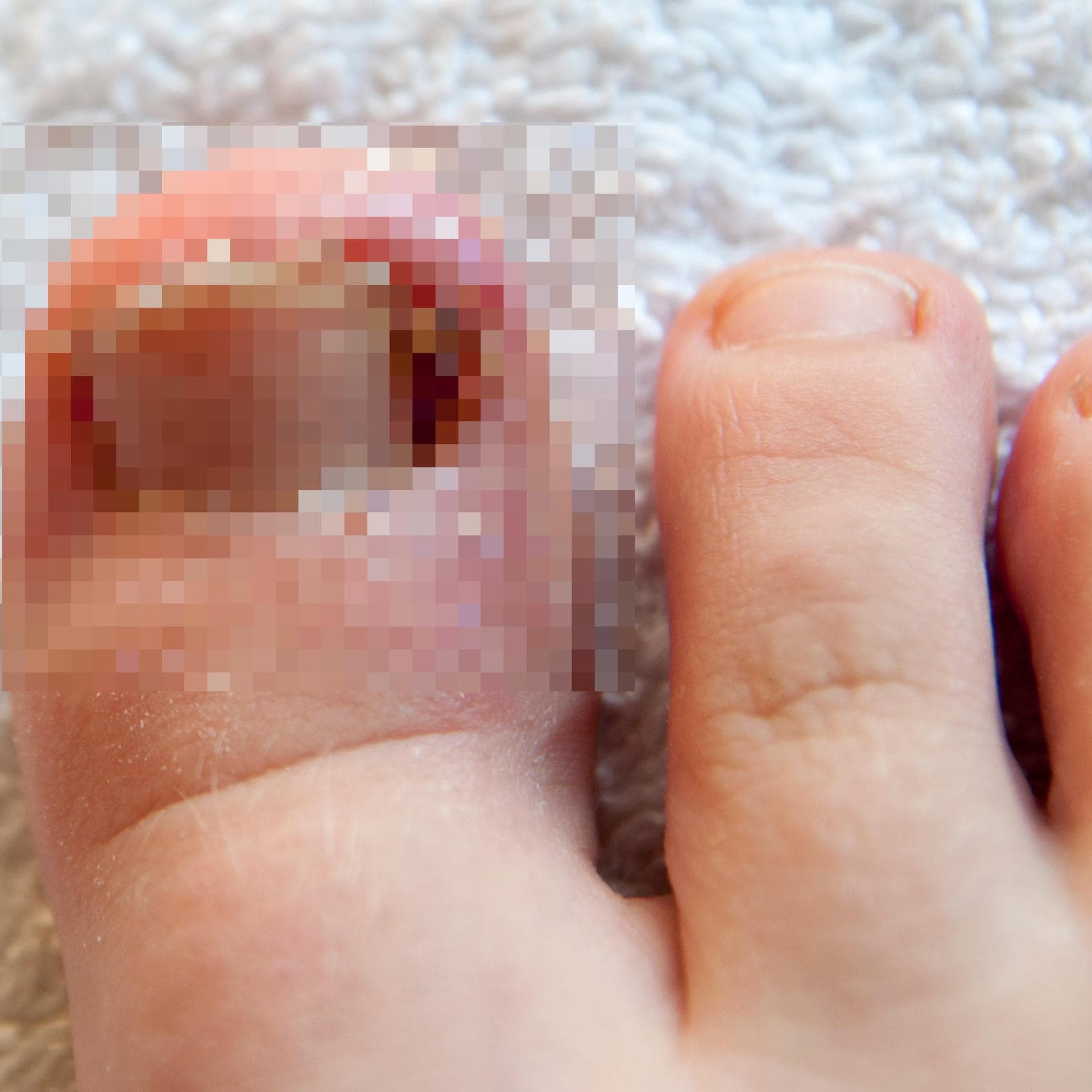 Ein eingewachsener Zehnagel kann Kinder ganz schön quälen.