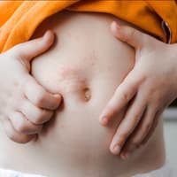 Eine Junge hat einen Hauttausschlag am Bauch. 
