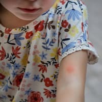 Mädchen mit Mückenstich am Arm