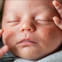 Baby mit Neugeborenenakne.