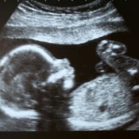 Ultraschallbild eines Babys.