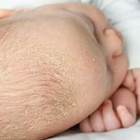Babykopf mit Kopfgneis