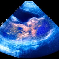 Ein Ultraschallbild, auf dem die Umrisse eines Babys zu erkennen sind