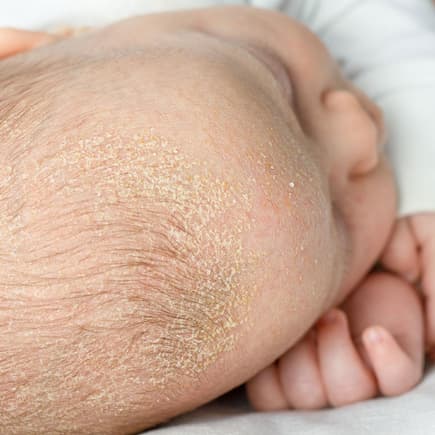 Babykopf mit Kopfgneis
