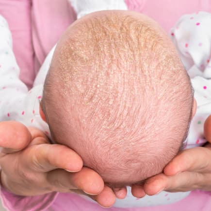 Kopf eines Babys mit Milchschorf