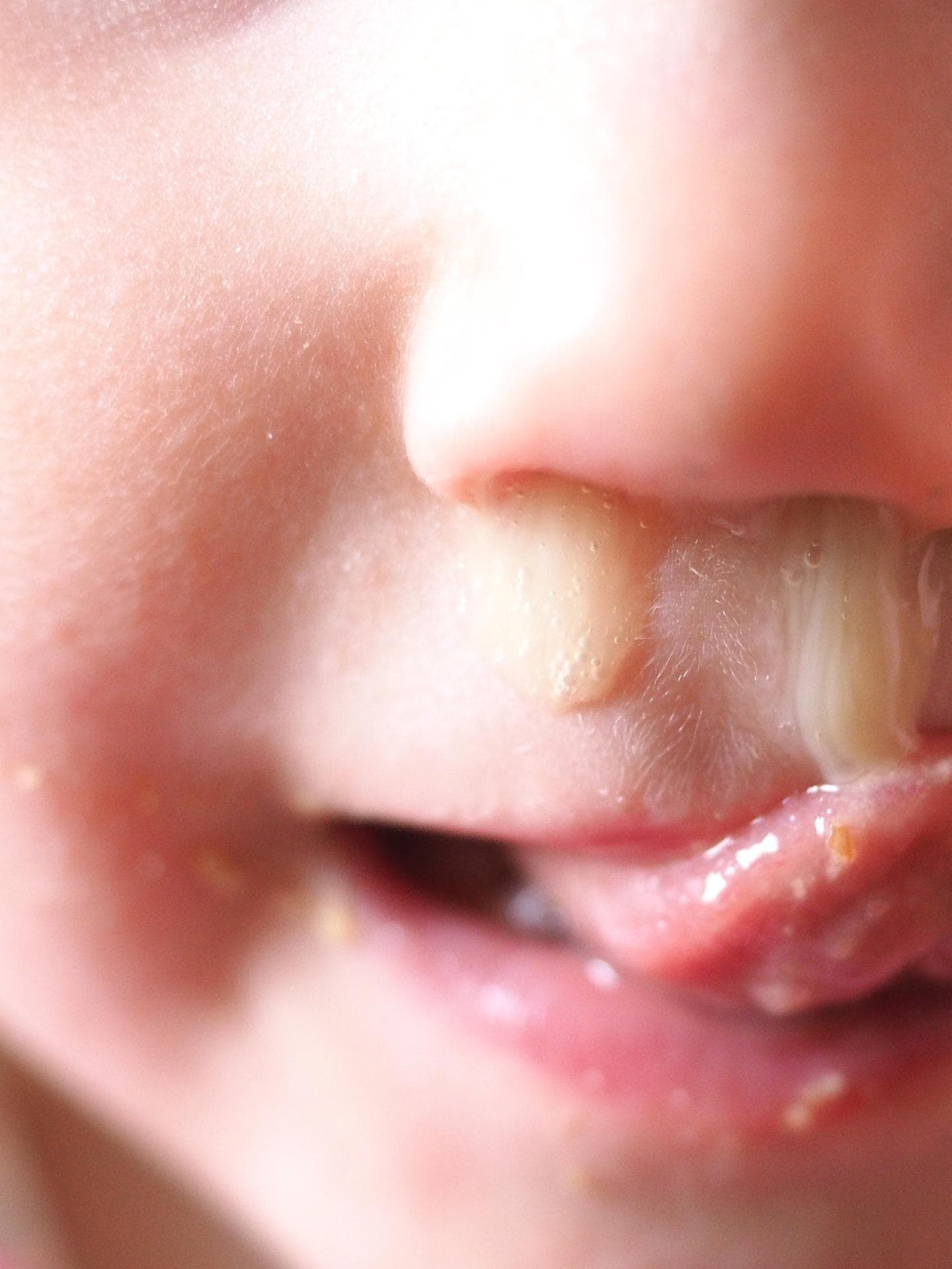 baby schnupfen weißer schleim