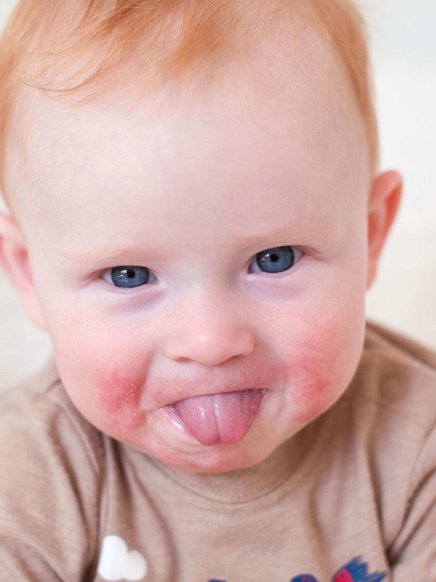 Achtung Allergien  schon bei Babys