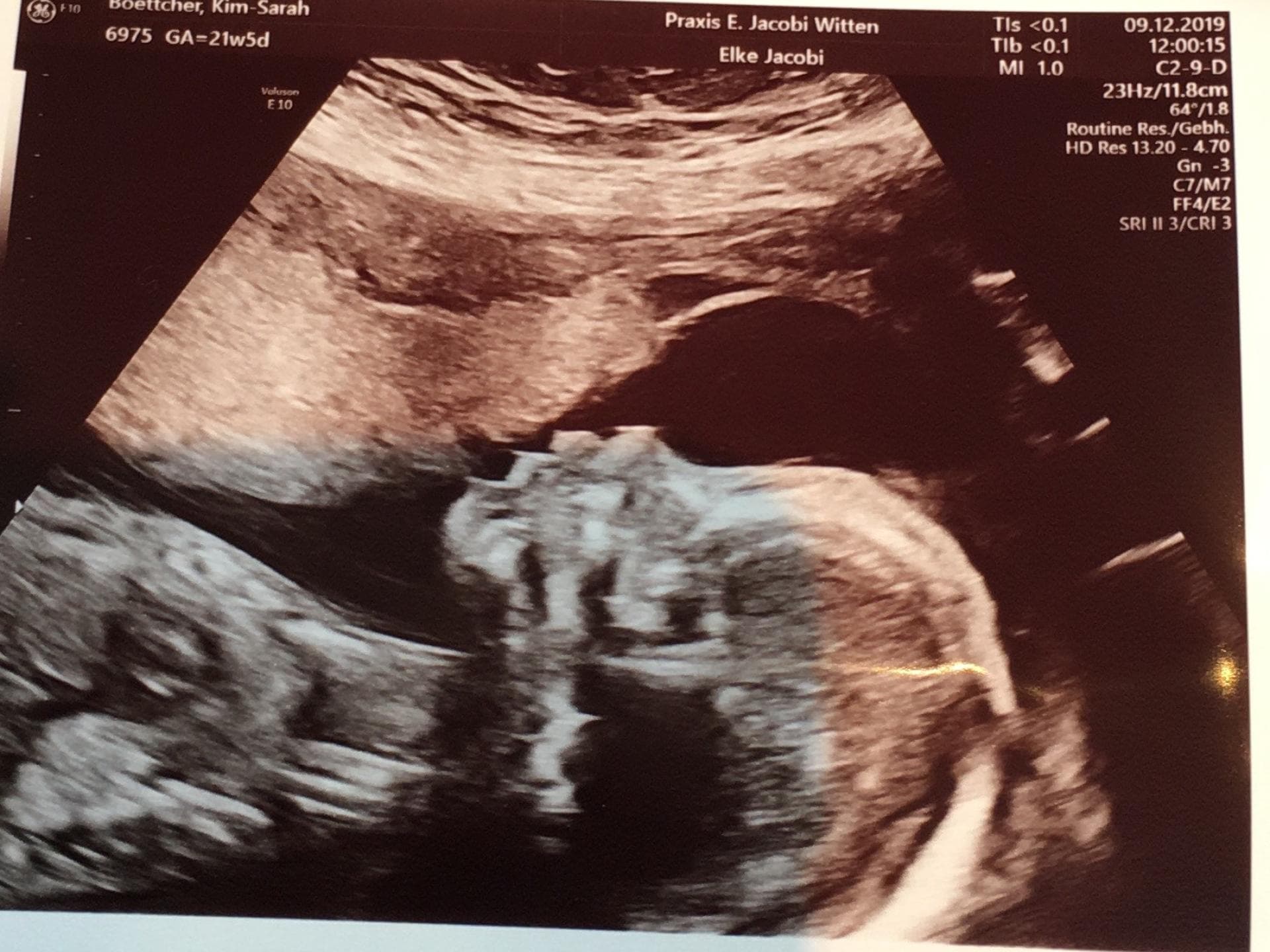 Ultraschallbild von Greta – sie hat das Williams-Beuren-Syndrom Ultraschallbild von Greta – sie hat das Williams-Beuren-Syndrom