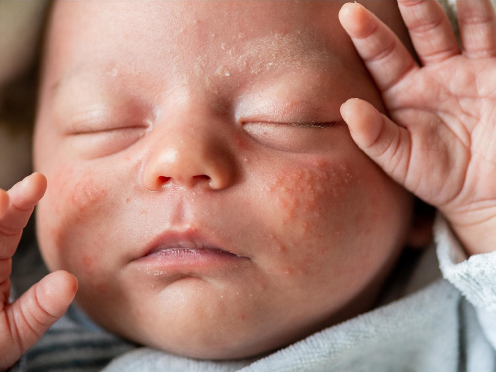 Baby mit Neugeborenenakne.