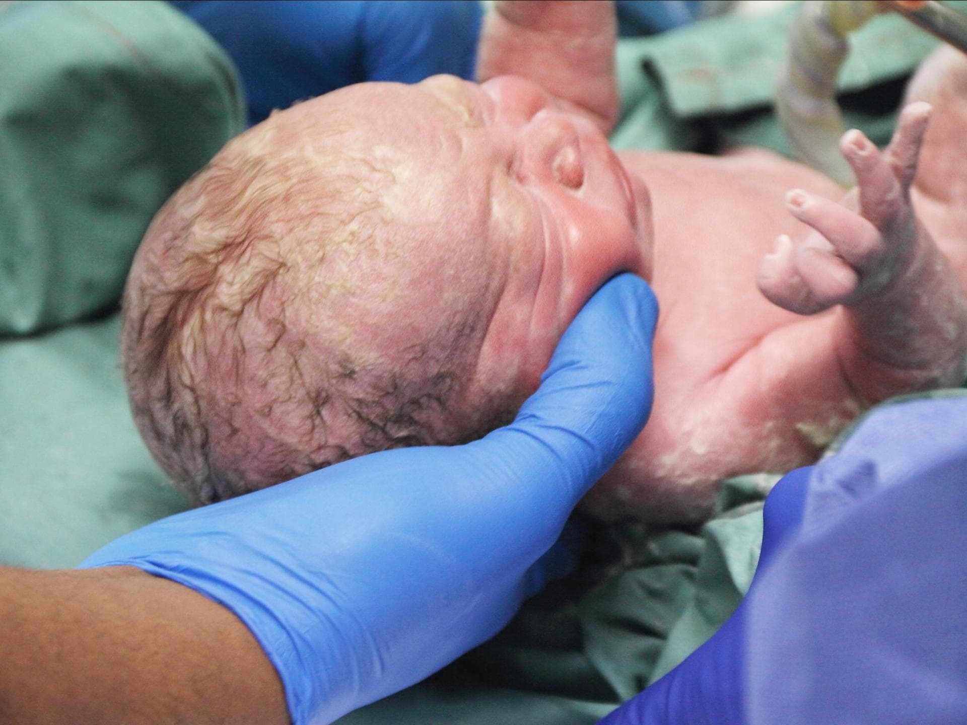 In seltenen Fällen können Babys beim Kaiserschnitt verletzt werden. Neugeborenes kurz nach der Geburt.
