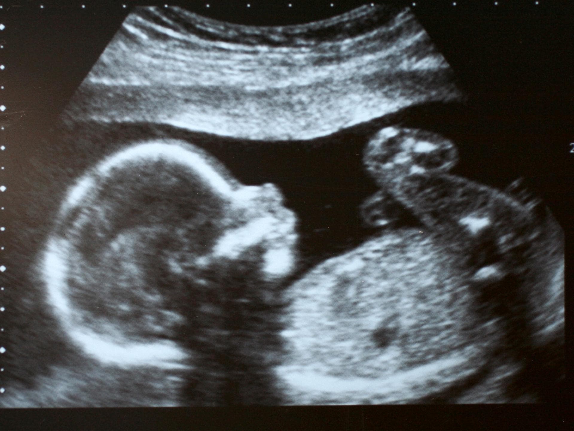 Ultraschallbild eines Babys.