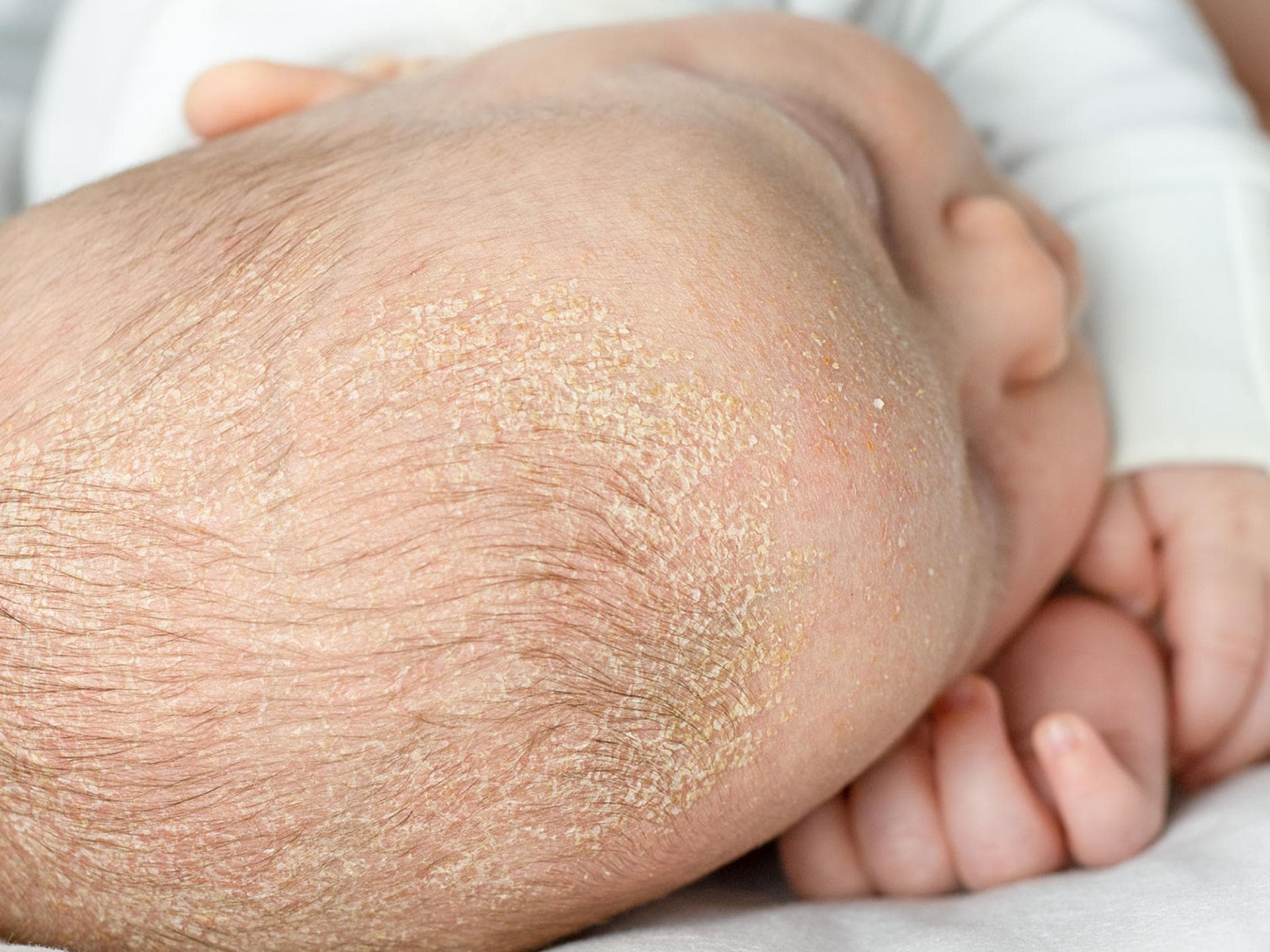 Kopfgneis ist eine Hautveränderung, die innerhalb der ersten drei Lebensmonate auftreten kann. Babykopf mit Kopfgneis