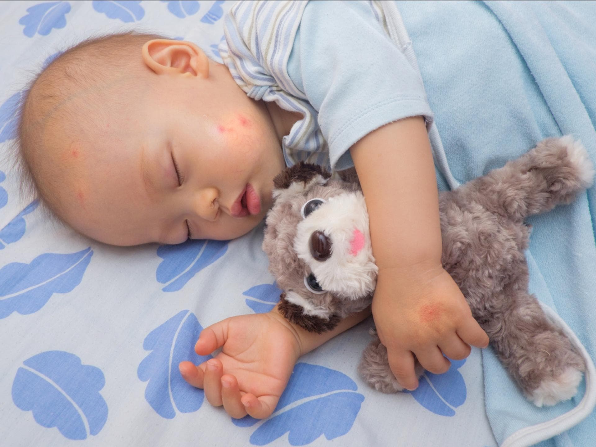 Auch beim Schlafen solltest du dein Baby vor Mücken schützen. Schlafendes Baby mit Mückenstichen im Gesicht.