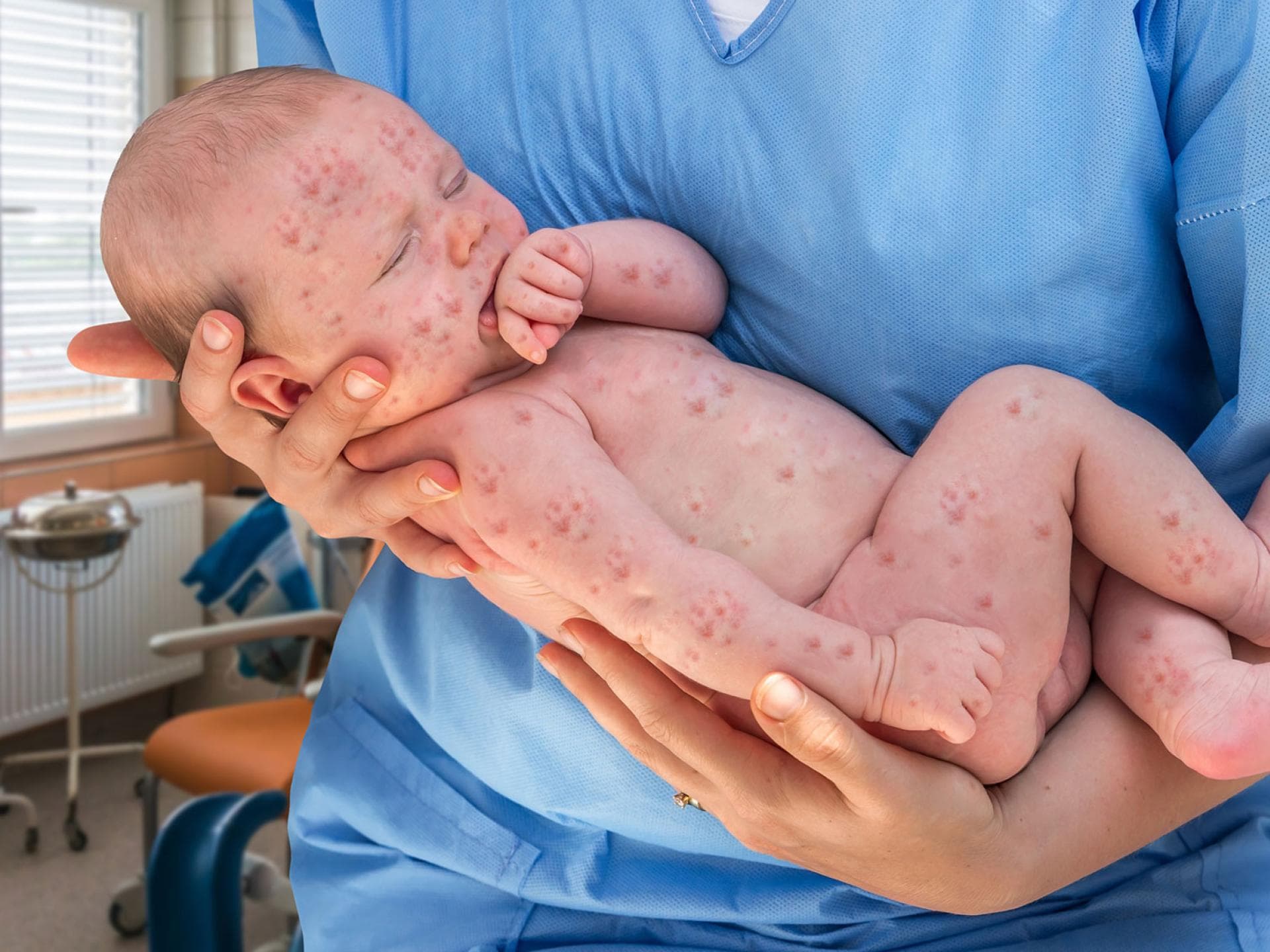 Ein heftiger Herpes-Ausbruch kann für Babys lebensgefährlich sein.