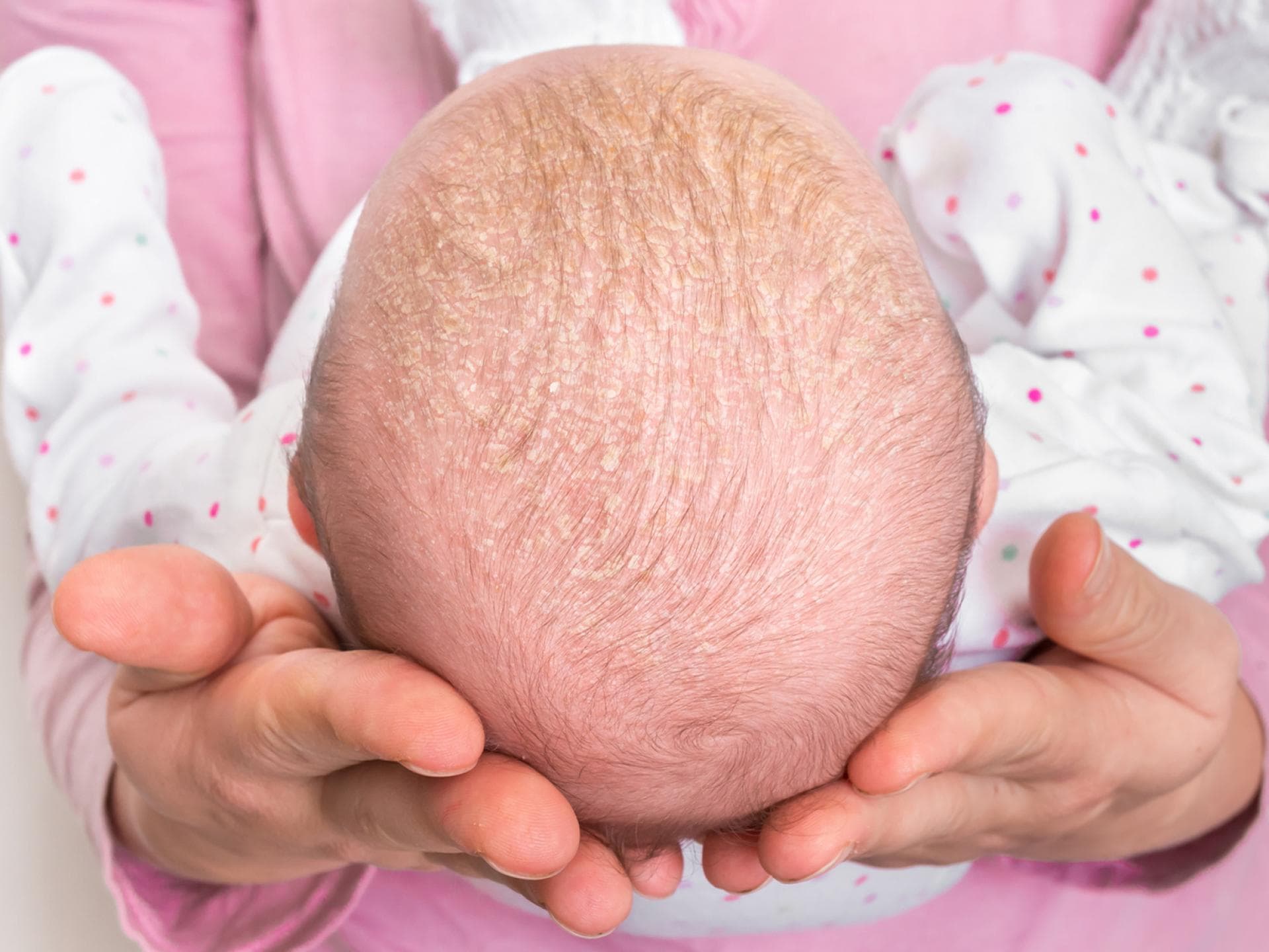 Bei Milchschorf braucht Babys Haut sanfte Pflege. Kopf eines Babys mit Milchschorf