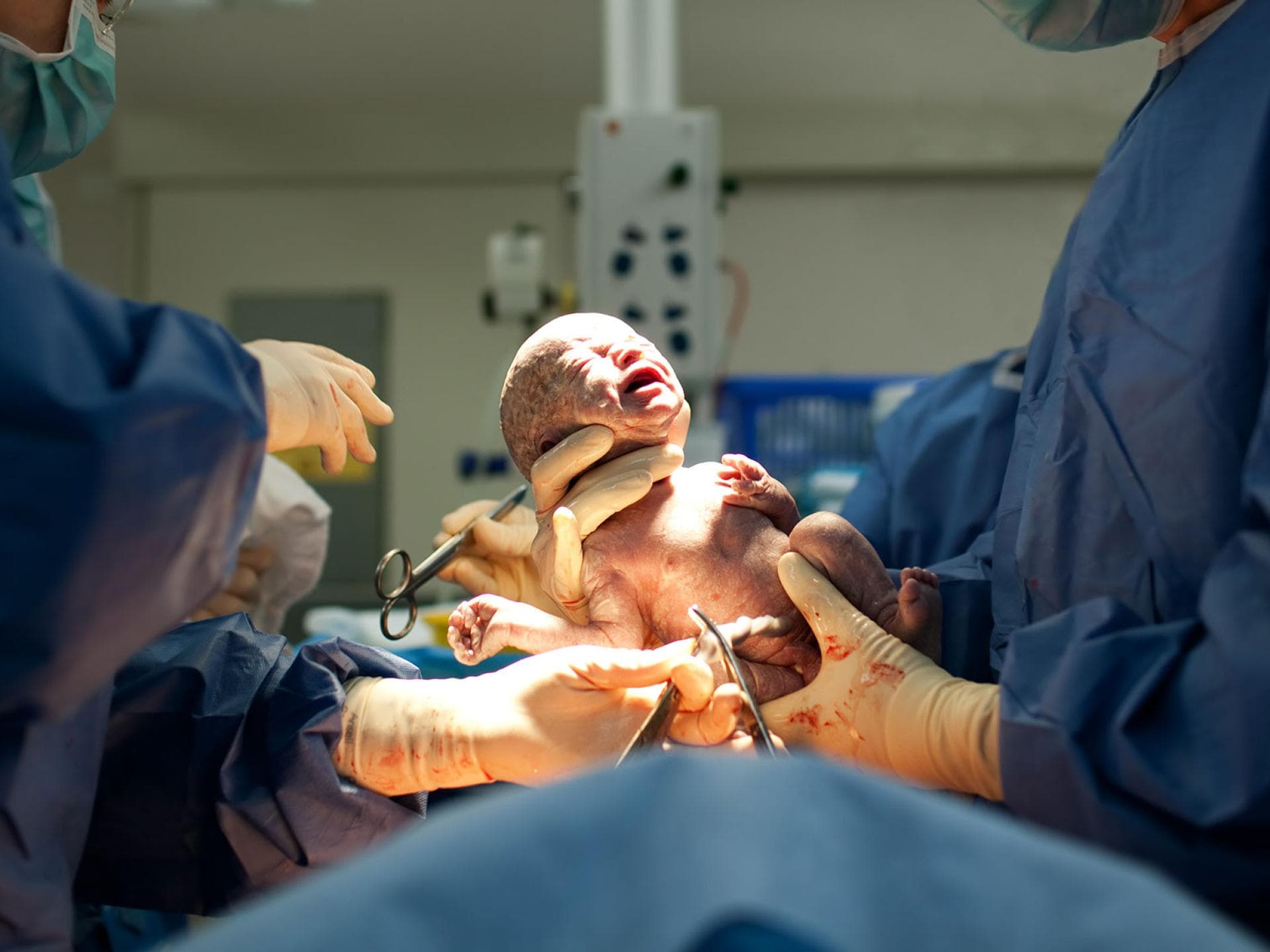 Ärzte im OP halten Baby direkt nach dem Kaiserschnitt.
