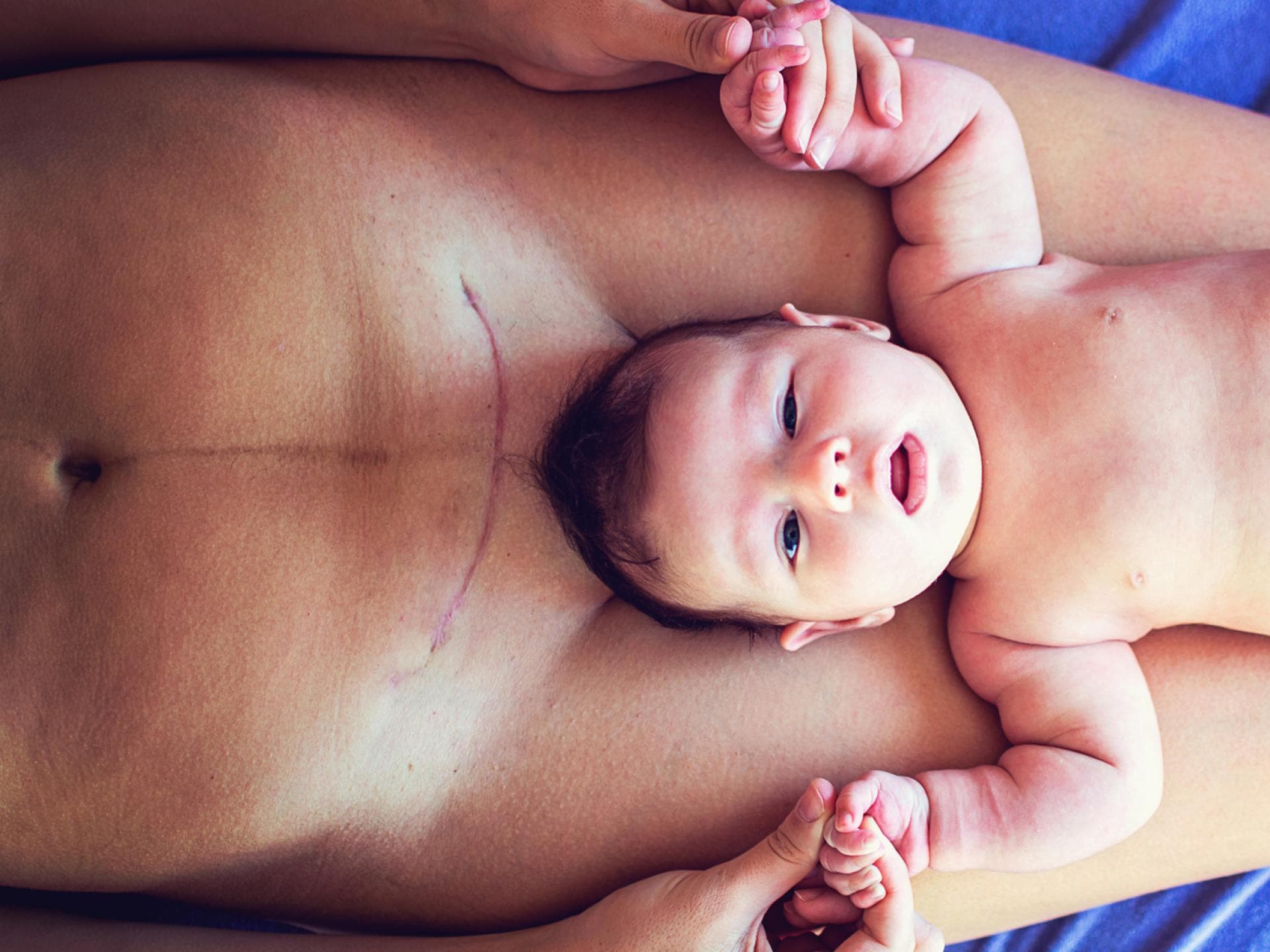 Viele Frauen sind sich unsicher, ob nach einem Kaiserschnitt eine natürliche Geburt noch möglich ist.  Baby liegt auf Mutter mit Kaiserschnittnarbe.