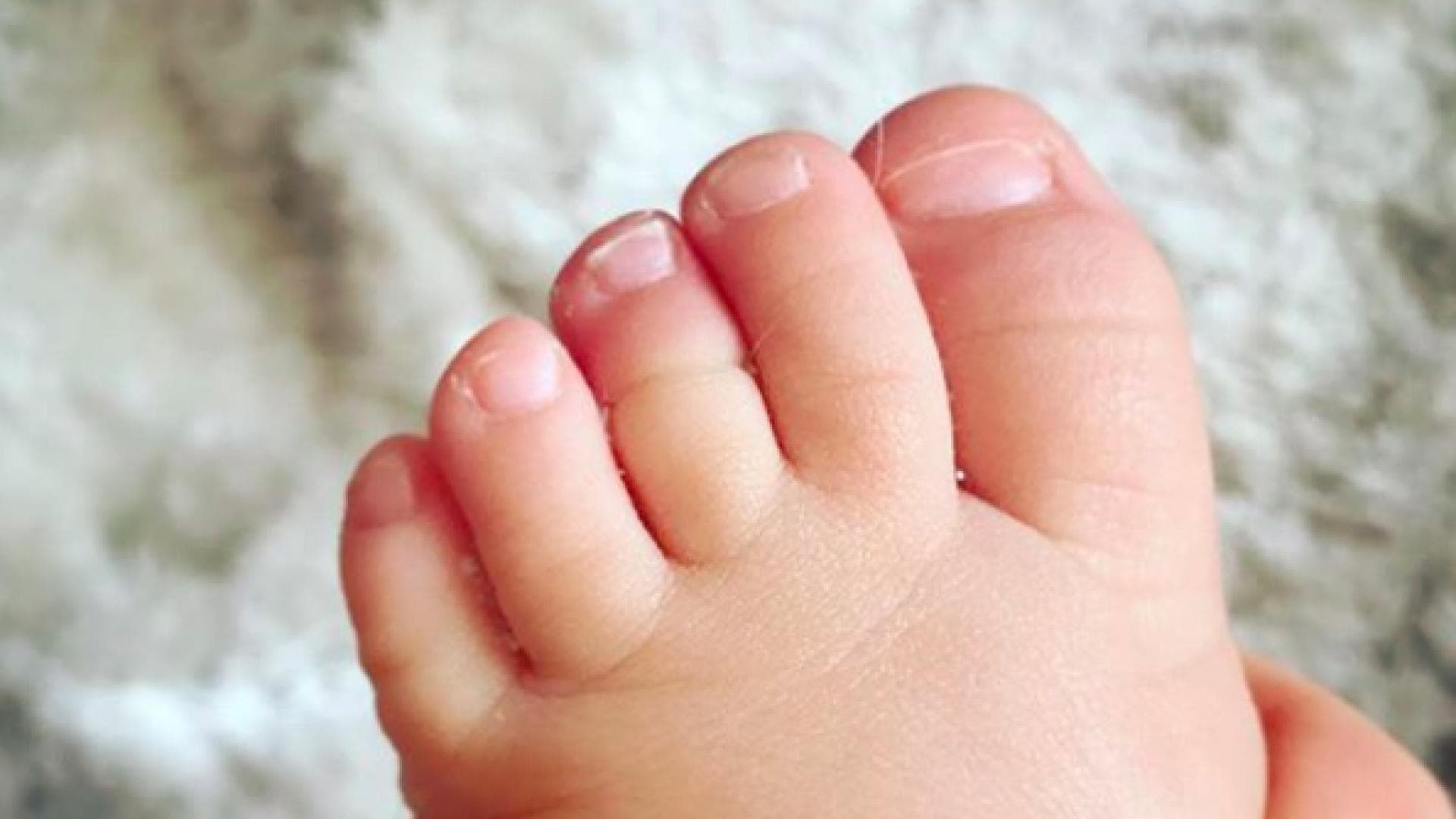 TourniquetSyndrom Wenn ein Haar Babys Zeh abschnürt